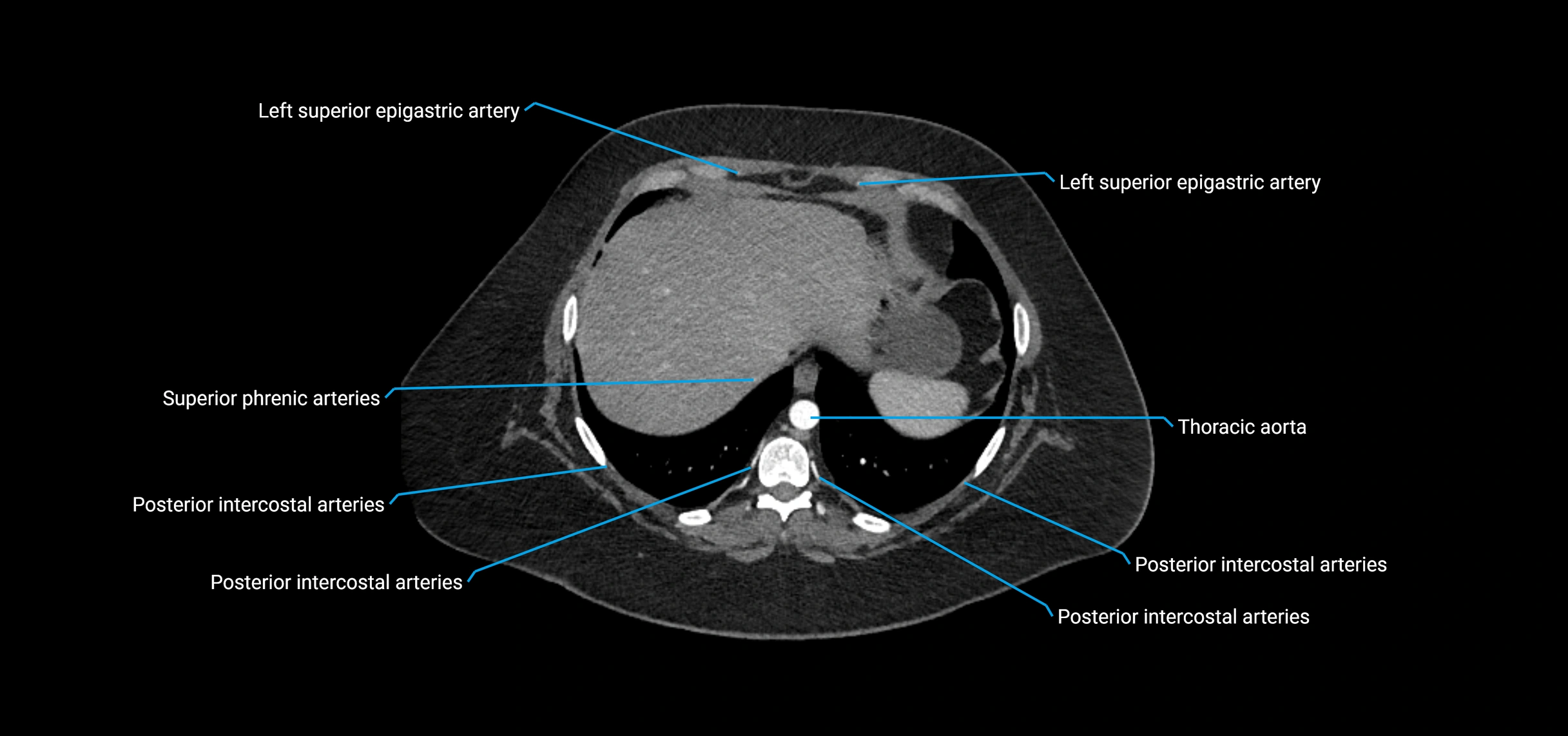 CTA abdomen axial cross sectional anatomy labelled image_20 (2).webp